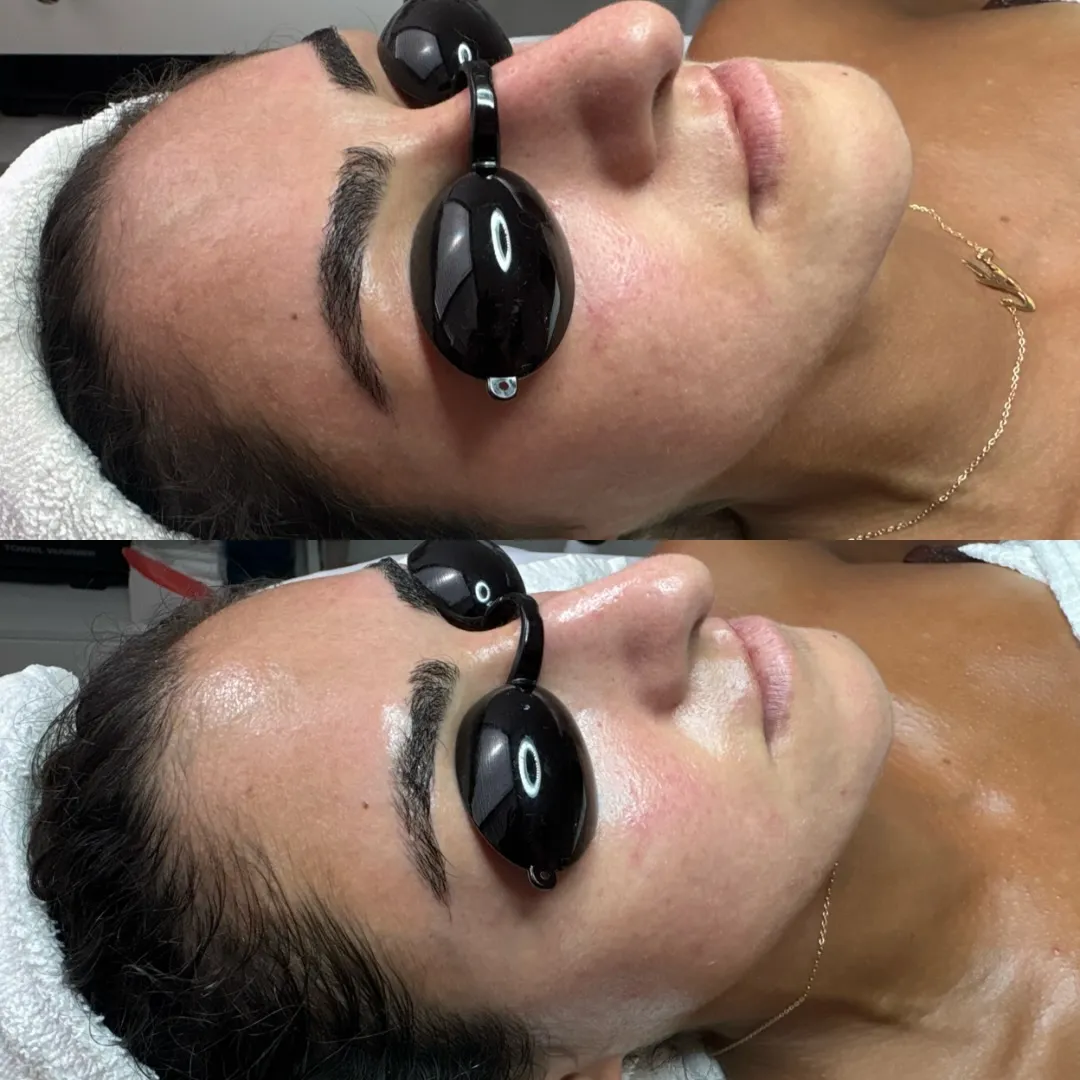 ☝️ Treatment BEFORE & AFTER 
.
Keeping it simple with Microdermabrasion & Oxi Trio by PCA. This is one of my go to’s to 