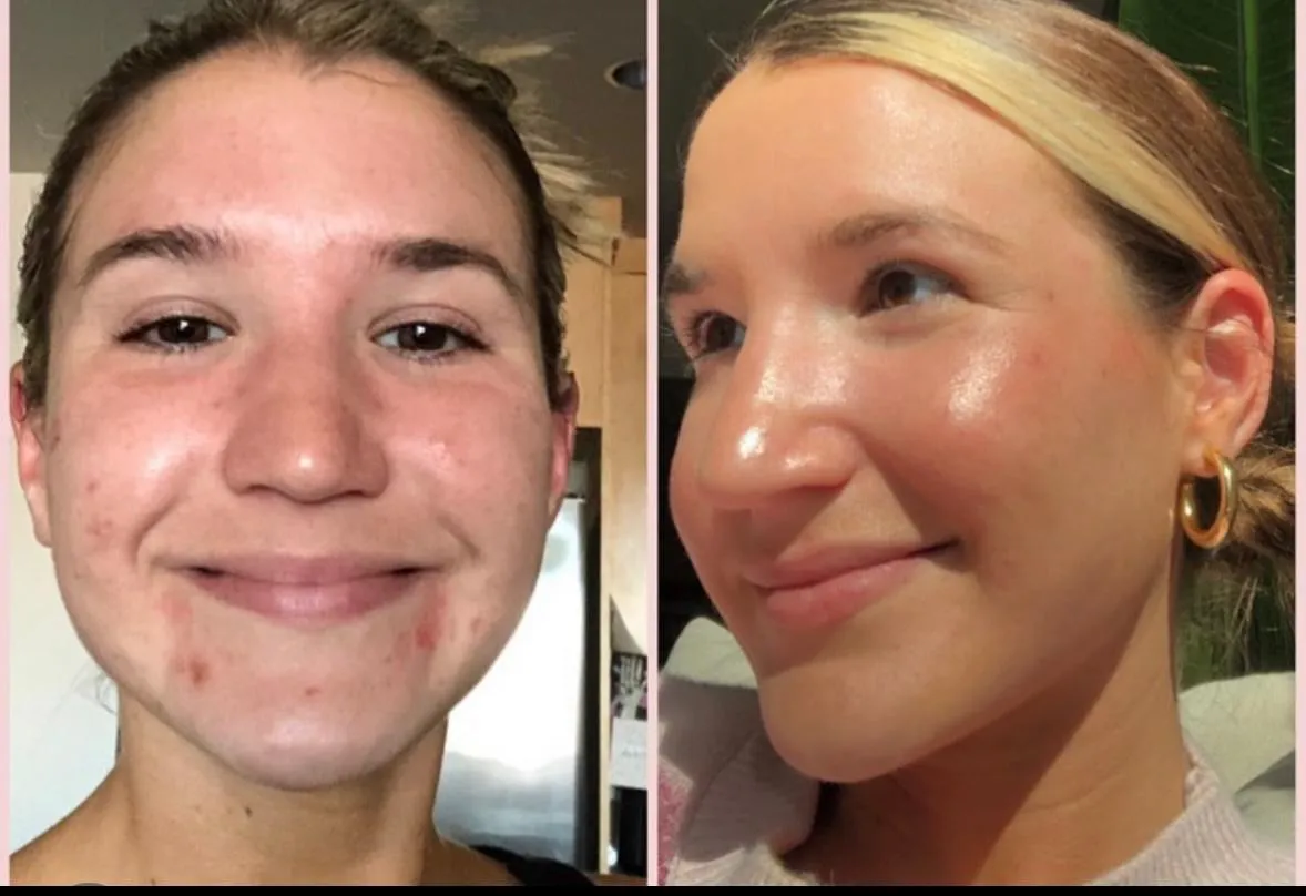 Before and after: acne and redness cleared, skin bright and even