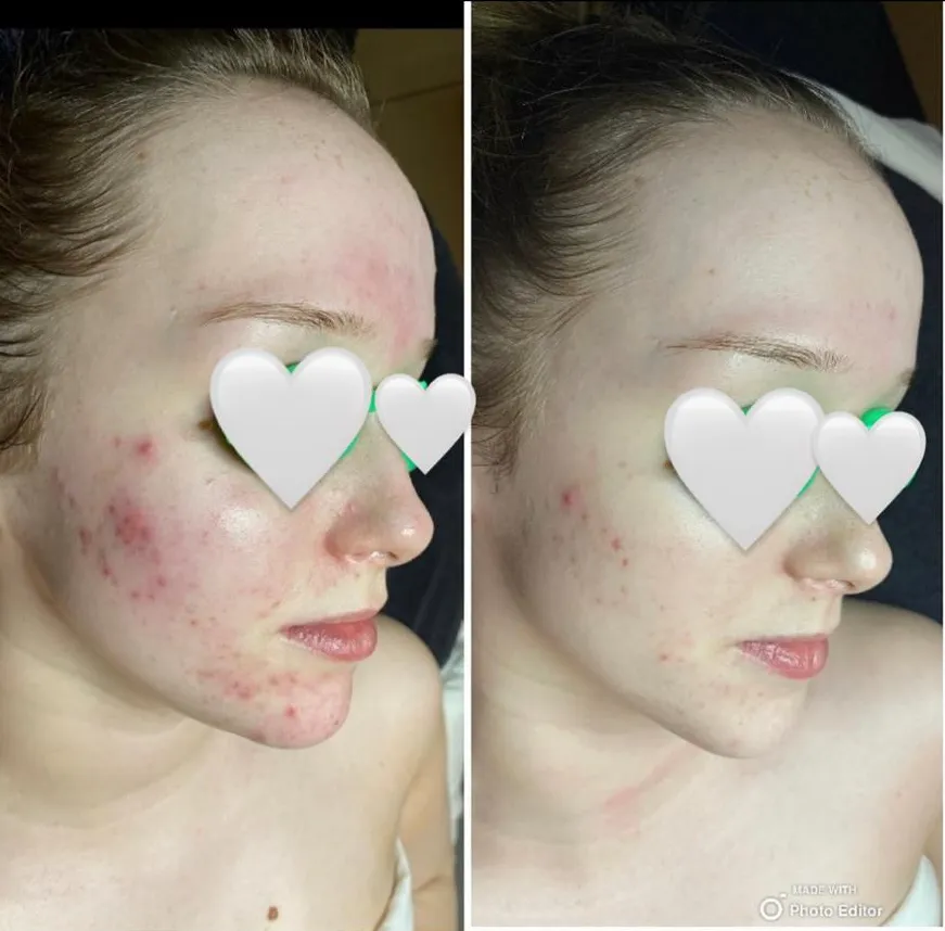 Before and after: inflamed cheek breakouts calmed and smoothed