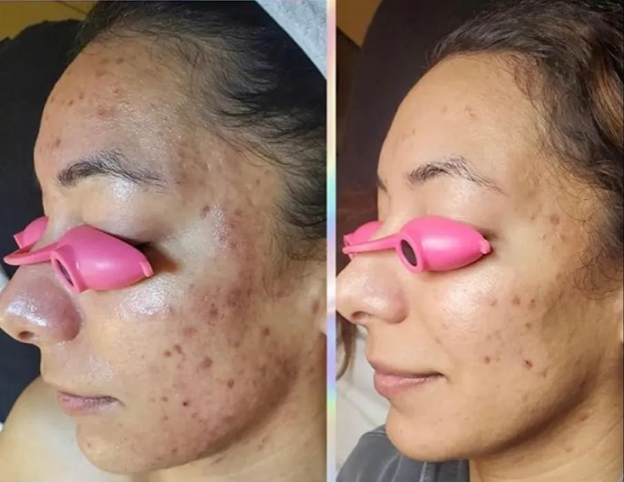 Before and after: post-acne marks faded, tone visibly evened